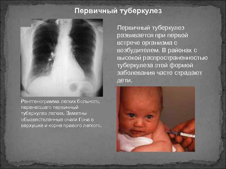 Первичный туберкулез развивается при первой встрече организма с возбудителем. В районах с высокой распространенностью