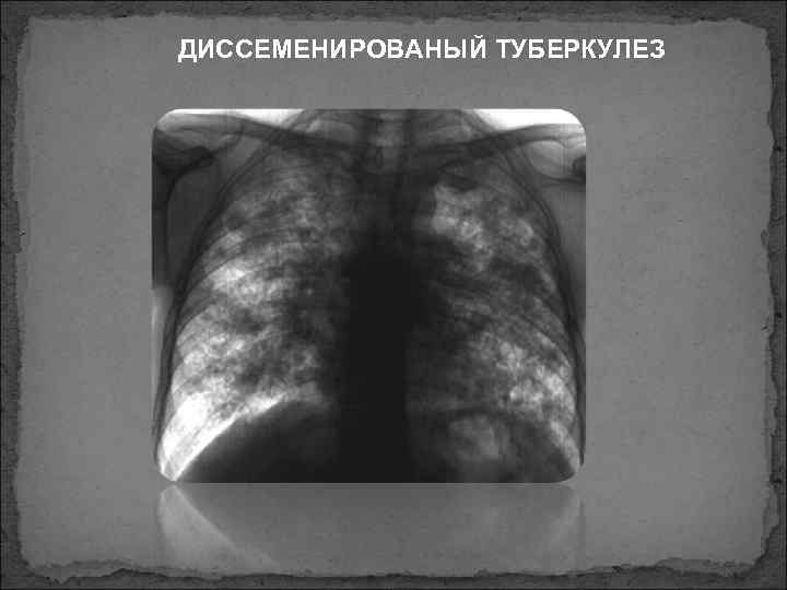 ДИССЕМЕНИРОВАНЫЙ ТУБЕРКУЛЕЗ 