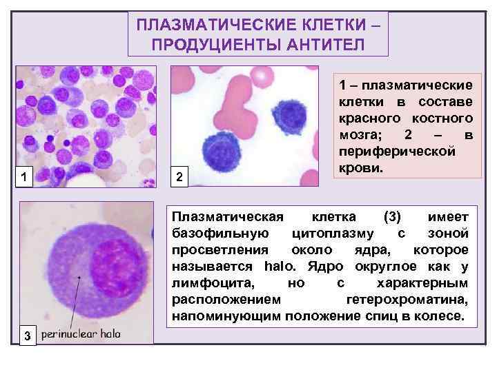 Плазматические клетки. Плазматическая клетка в анализе крови. Плазмоциты в периферической крови. Плазматические клетки в периферической крови. Плазмоциты в периферической крови обнаруживаются при.