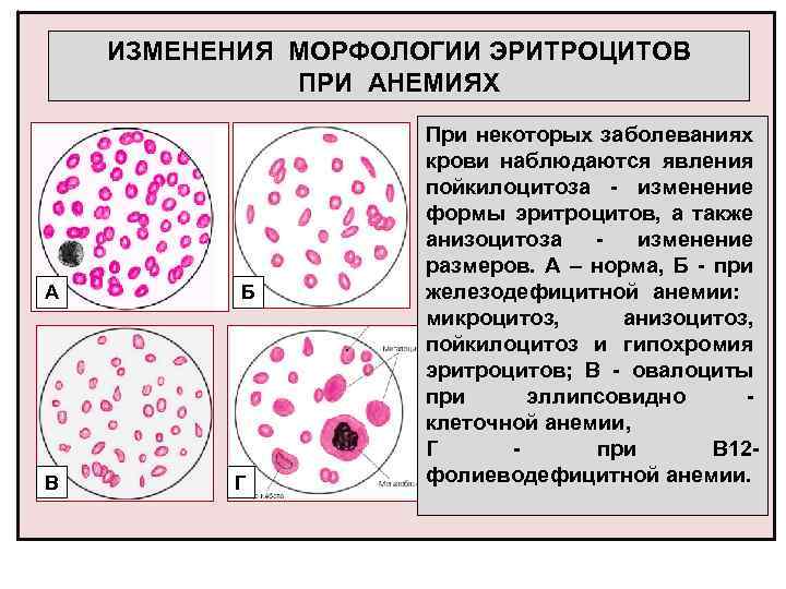 Изменение клеток крови. Морфология эритроцитов при анемиях. Сидеробластная анемия морфология крови. Анизоцитоз микроцитоз. Изменение морфологии эритроцитов при анемиях.