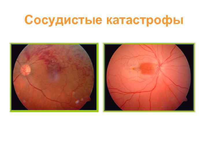 Сосудистые катастрофы 