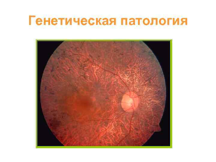 Генетическая патология 