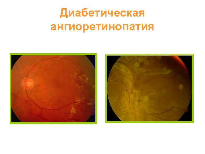 Диабетическая ангиоретинопатия 