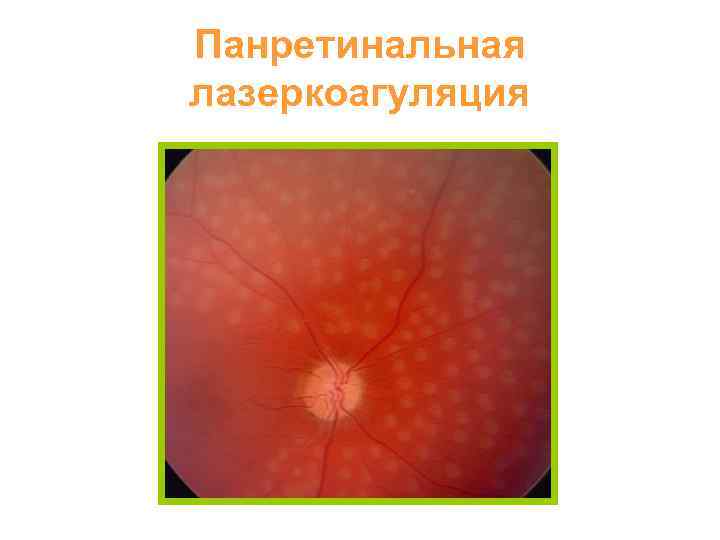 Панретинальная лазеркоагуляция 
