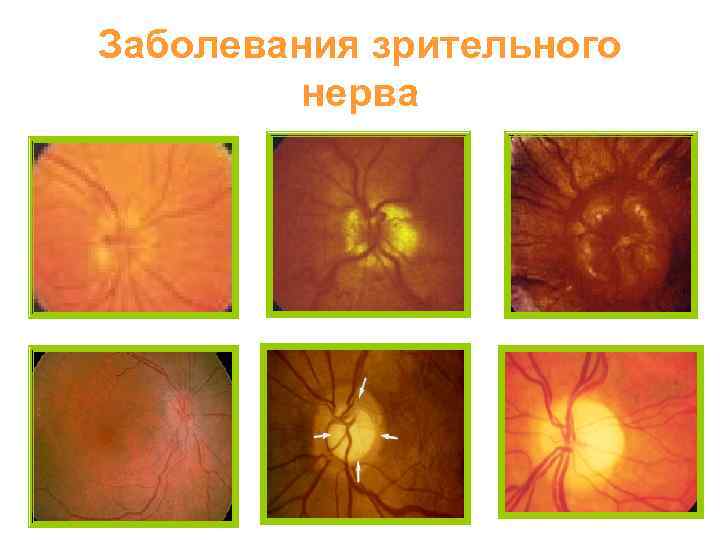 Заболевания зрительного нерва 