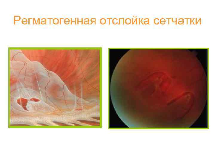 Регматогенная отслойка сетчатки 