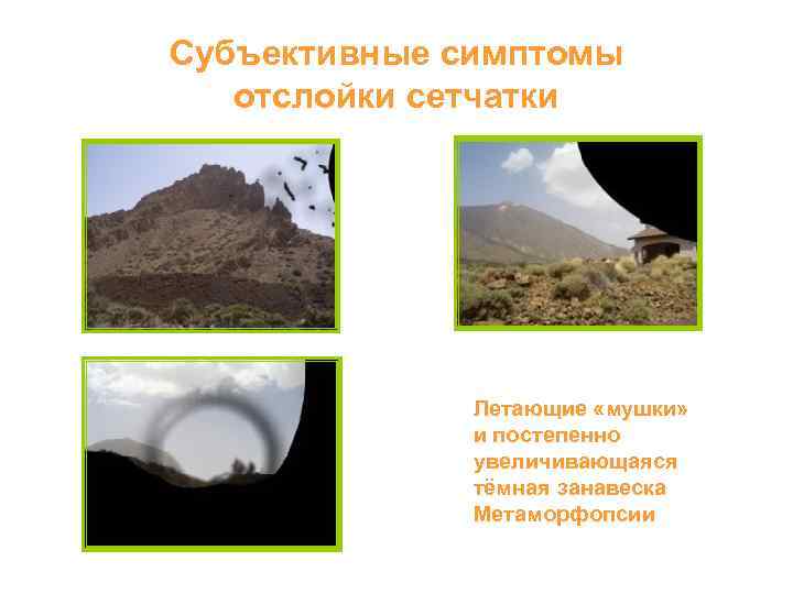 Субъективные симптомы отслойки сетчатки Летающие «мушки» и постепенно увеличивающаяся тёмная занавеска Метаморфопсии 