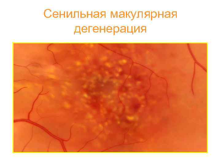 Сенильная макулярная дегенерация 