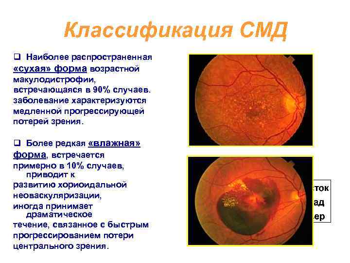 Возрастная макулодистрофия презентация