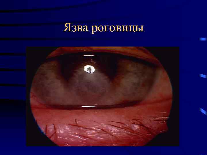 Язва роговицы 