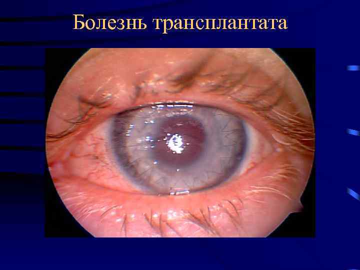 Болезнь трансплантата 
