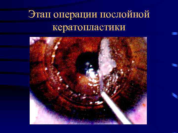 Этап операции послойной кератопластики 