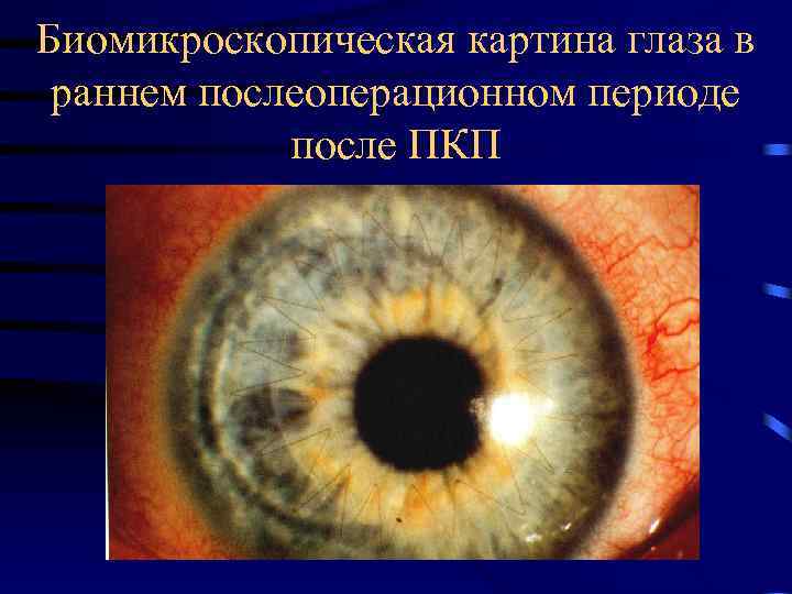 Биомикроскопическая картина глаза в раннем послеоперационном периоде после ПКП 