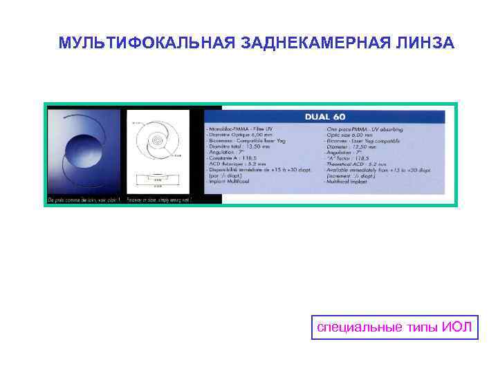 МУЛЬТИФОКАЛЬНАЯ ЗАДНЕКАМЕРНАЯ ЛИНЗА специальные типы ИОЛ 