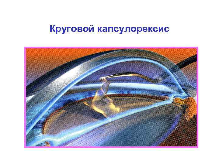 Круговой капсулорексис 