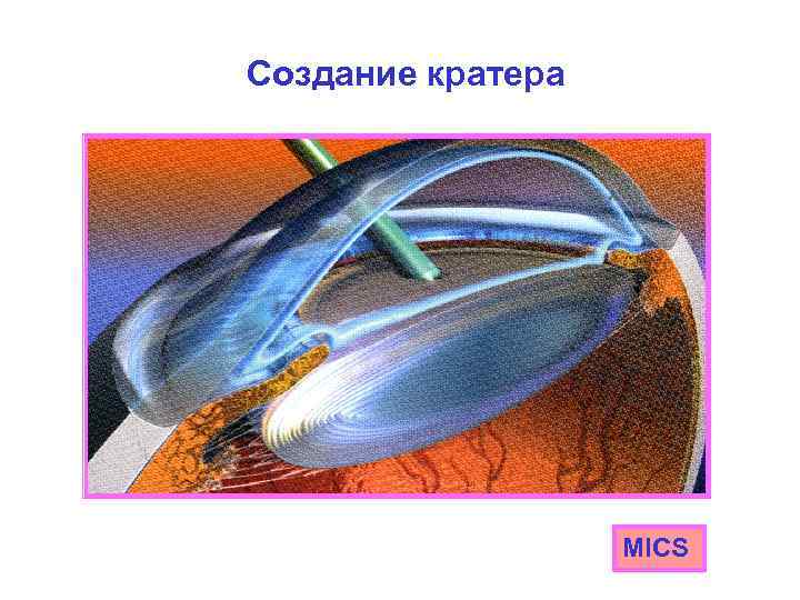 Создание кратера MICS 