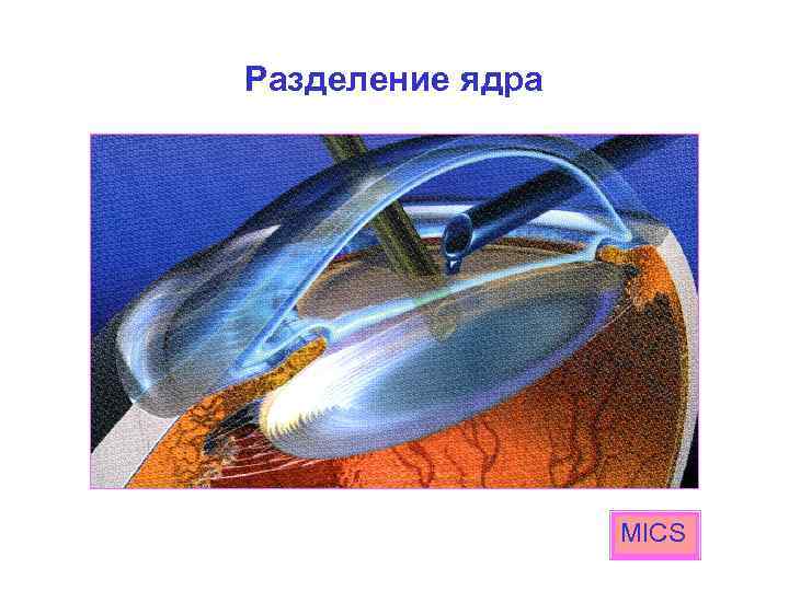 Разделение ядра MICS 