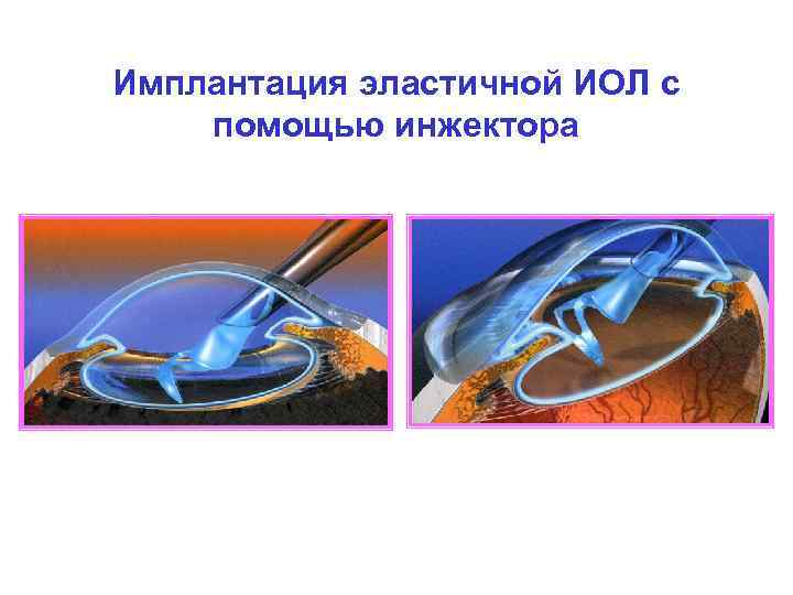 Имплантация эластичной ИОЛ с помощью инжектора 