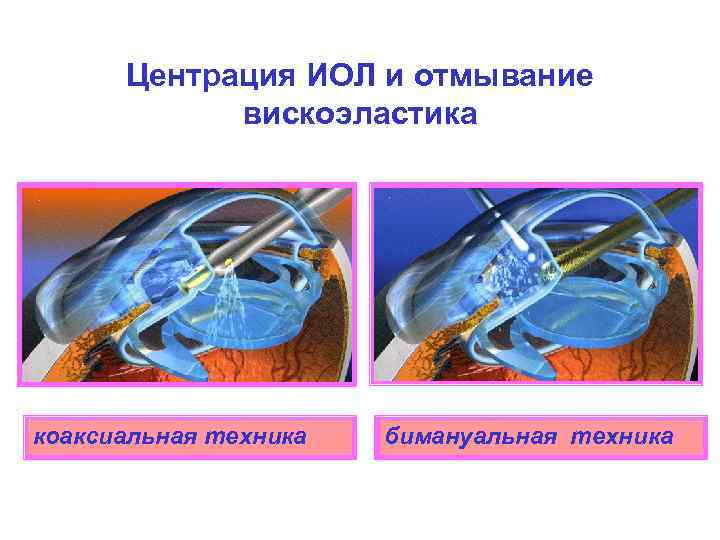 Центрация ИОЛ и отмывание вискоэластика коаксиальная техника бимануальная техника 