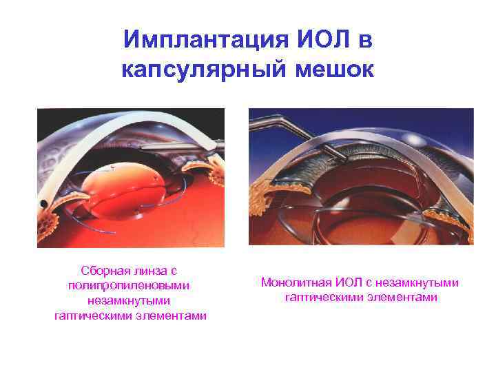 Имплантация ИОЛ в капсулярный мешок Сборная линза с полипропиленовыми незамкнутыми гаптическими элементами Монолитная ИОЛ