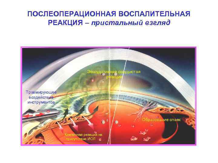 ПОСЛЕОПЕРАЦИОННАЯ ВОСПАЛИТЕЛЬНАЯ РЕАКЦИЯ – пристальный взгляд Экссудативная сосудистая реакция Травмирующее воздействие инструментов Образование спаек