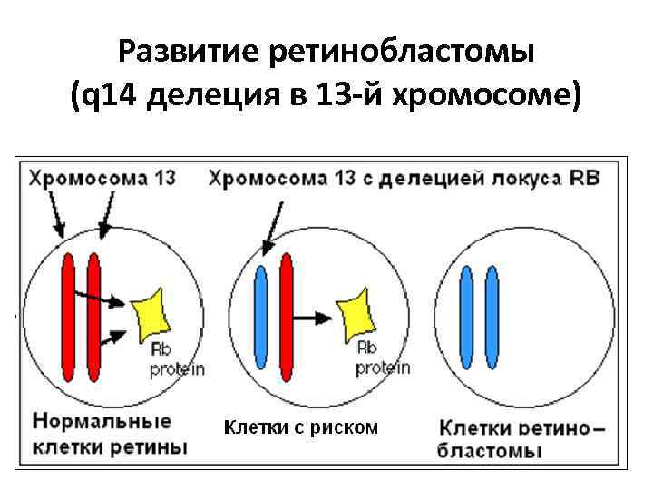 Развитие ретинобластомы (q 14 делеция в 13 -й хромосоме) 