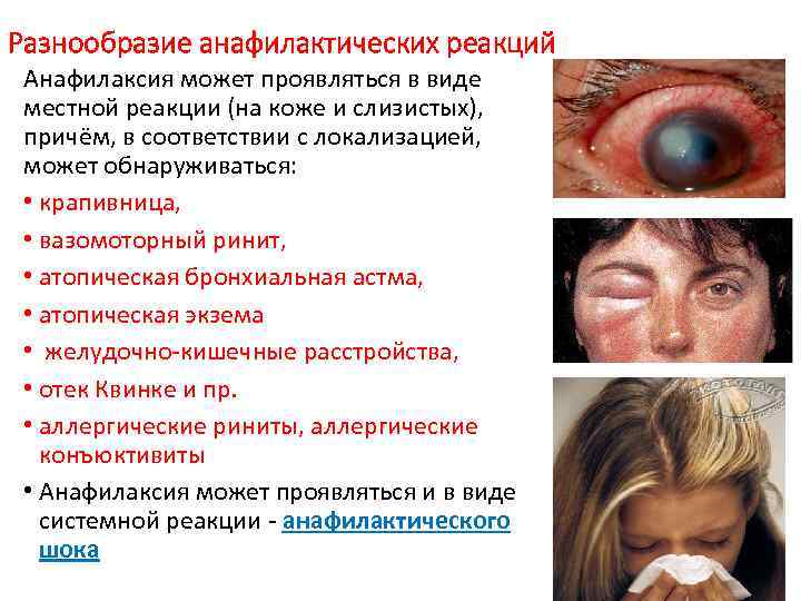 Разнообразие анафилактических реакций Анафилаксия может проявляться в виде местной реакции (на коже и слизистых),