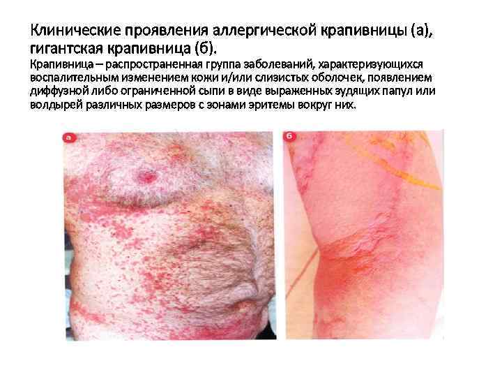 Клинические проявления аллергической крапивницы (а), гигантская крапивница (б). Крапивница – распространенная группа заболеваний, характеризующихся