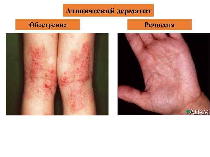 Атопический дерматит Обострение Ремиссия 30 
