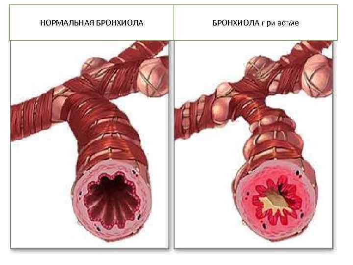 НОРМАЛЬНАЯ БРОНХИОЛА при астме 