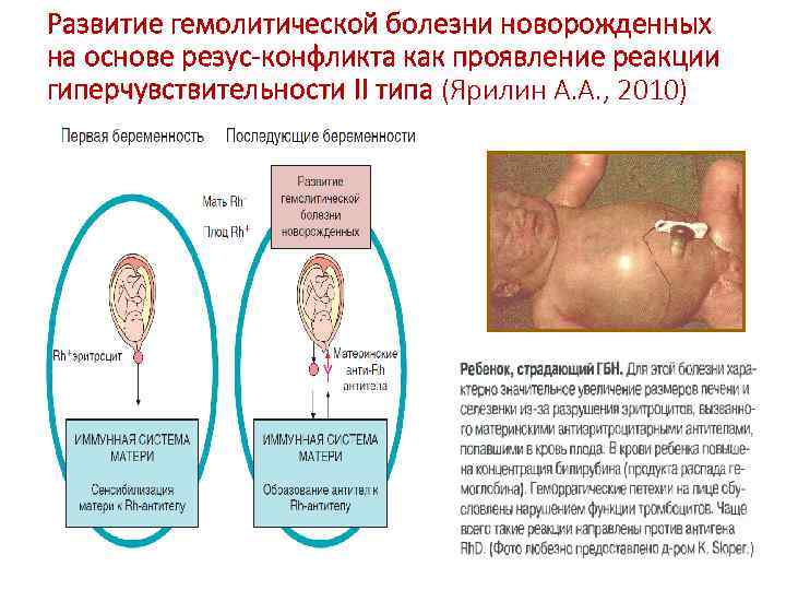 Развитие гемолитической болезни новорожденных на основе резус-конфликта как проявление реакции гиперчувствительности II типа (Ярилин