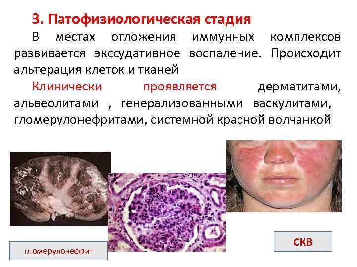 3. Патофизиологическая стадия В местах отложения иммунных комплексов развивается экссудативное воспаление. Происходит альтерация клеток