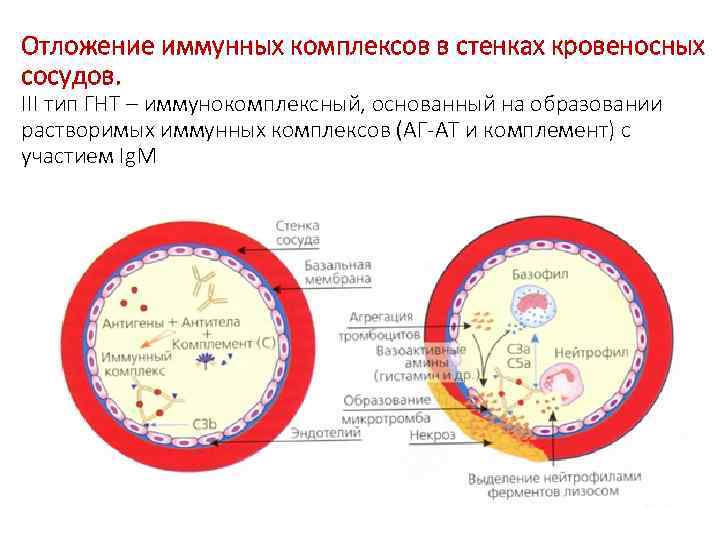 Отложение иммунных комплексов в стенках кровеносных сосудов. III тип ГНТ – иммунокомплексный, основанный на