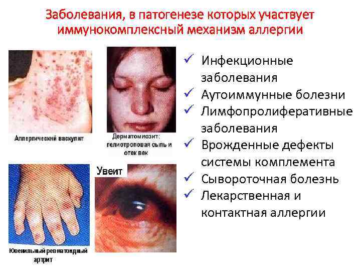 Заболевания, в патогенезе которых участвует иммунокомплексный механизм аллергии ü Инфекционные заболевания ü Аутоиммунные болезни