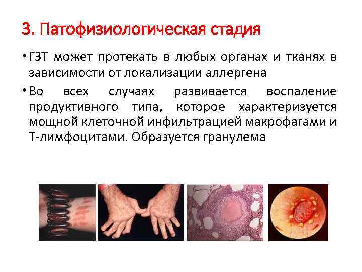 3. Патофизиологическая стадия • ГЗТ может протекать в любых органах и тканях в зависимости