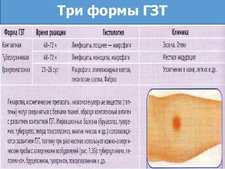 Три формы ГЗТ 