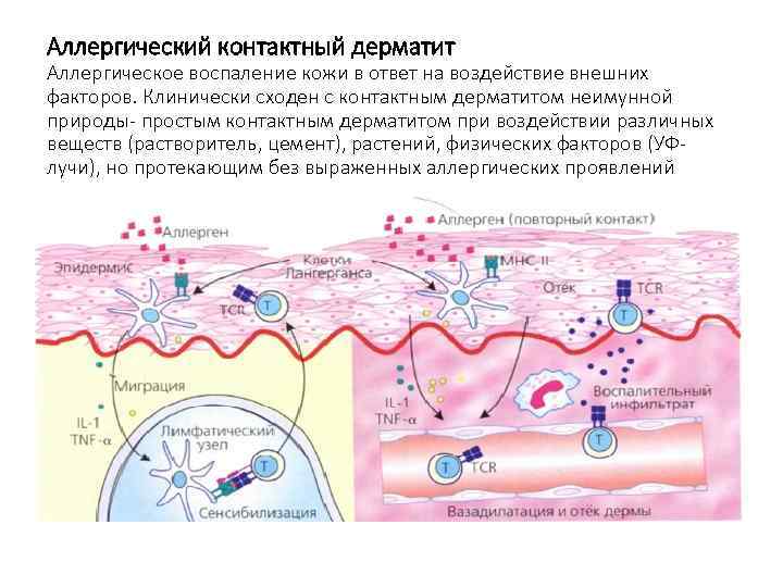 Аллергический контактный дерматит Аллергическое воспаление кожи в ответ на воздействие внешних факторов. Клинически сходен