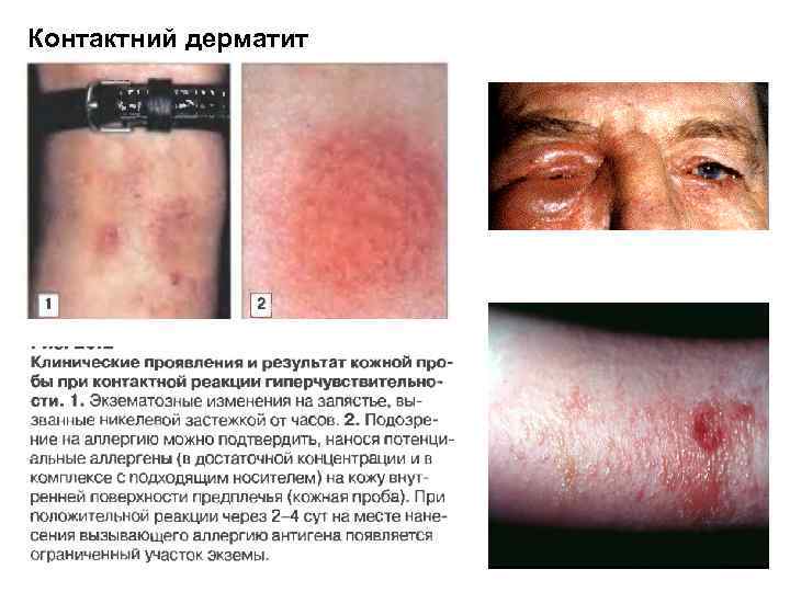 Контактний дерматит 