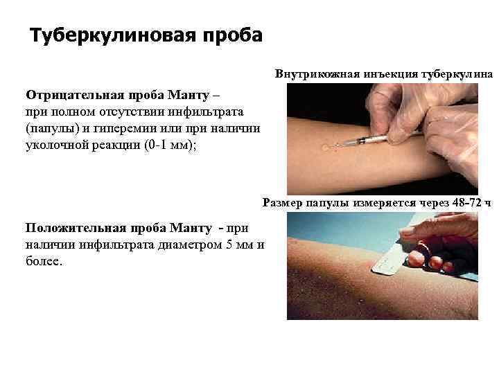 Туберкулиновая проба Внутрикожная инъекция туберкулина Отрицательная проба Манту – при полном отсутствии инфильтрата (папулы)