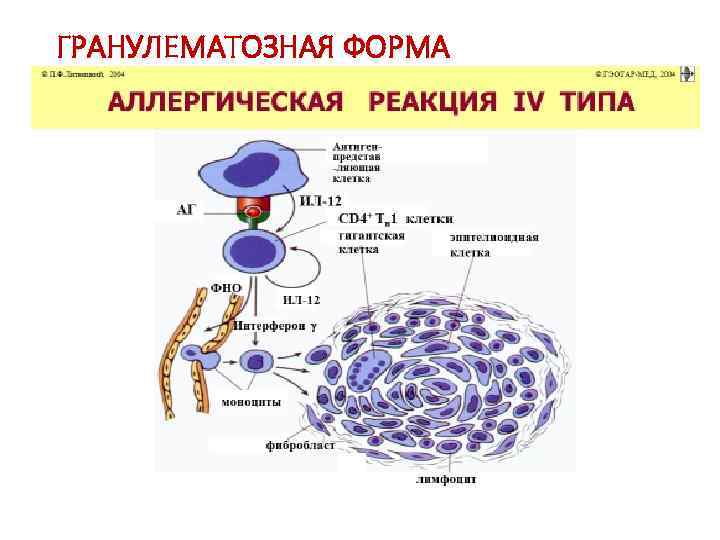 ГРАНУЛЕМАТОЗНАЯ ФОРМА 
