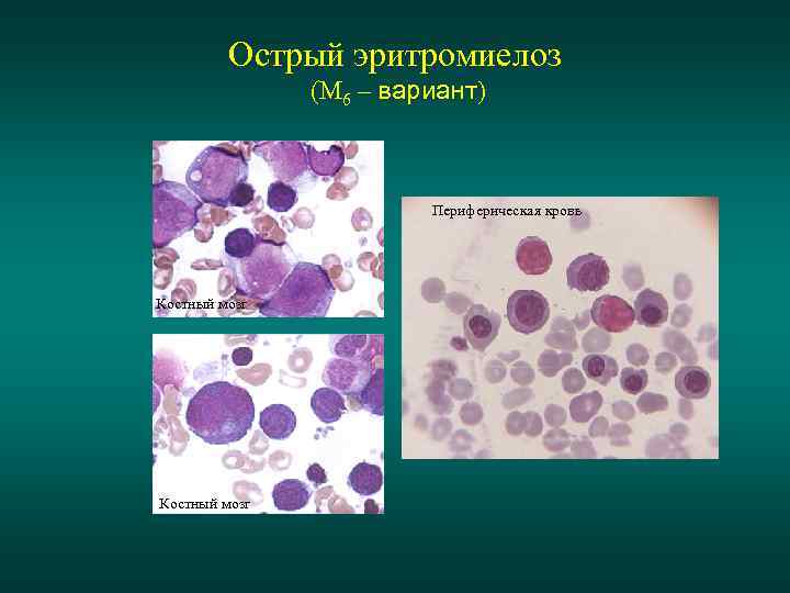 Острый эритромиелоз (М 6 – вариант) Периферическая кровь Костный мозг 