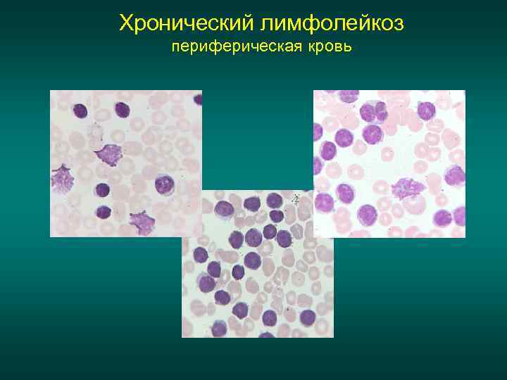 Хронический лимфолейкоз периферическая кровь 