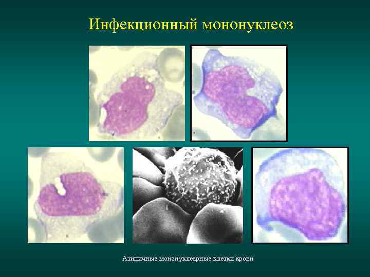 Инфекционный мононуклеоз Атипичные мононуклеарные клетки крови 