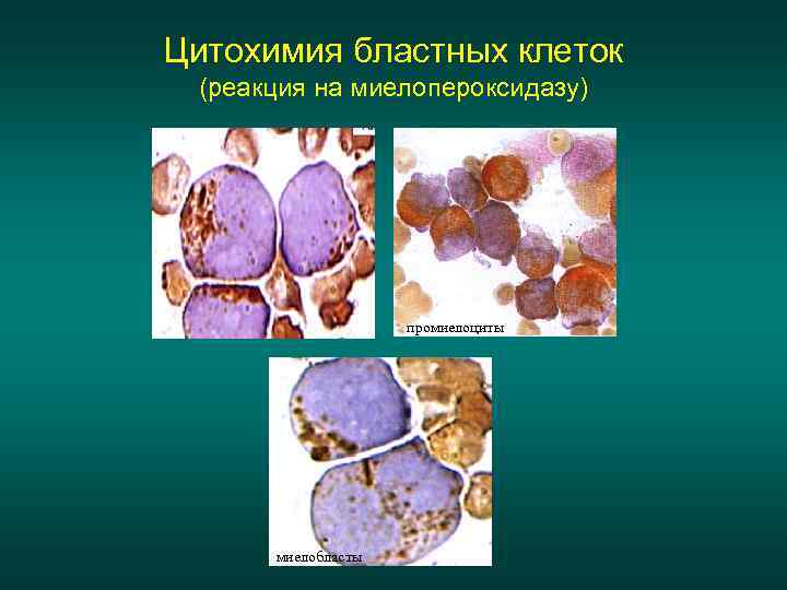 Цитохимия бластных клеток (реакция на миелопероксидазу) промиелоциты миелобласты 