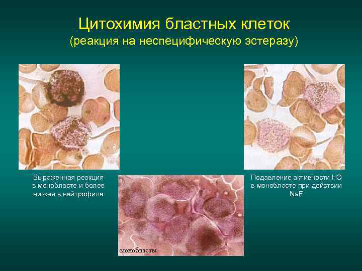 Цитохимия бластных клеток (реакция на неспецифическую эстеразу) Выраженная реакция в монобласте и более низкая
