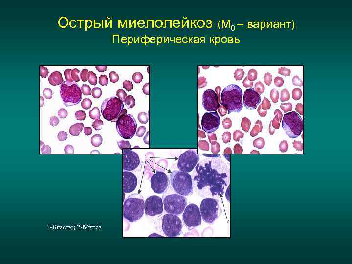 Острый миелолейкоз (М 0 – вариант) Периферическая кровь 1 -Бласты; 2 -Митоз 