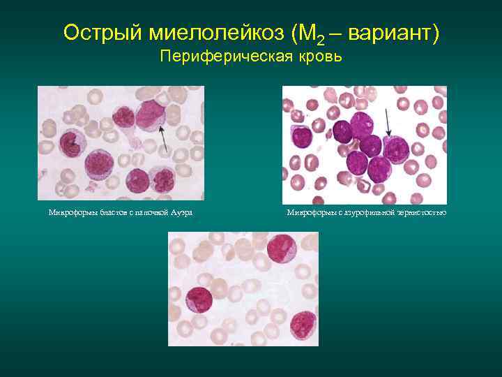 Острый миелолейкоз (М 2 – вариант) Периферическая кровь Микроформы бластов с палочкой Ауэра Микроформы