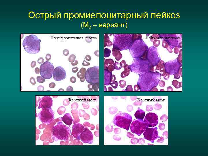 Острый промиелоцитарный лейкоз (М 3 – вариант) Периферическая кровь Костный мозг Лейкоконцентрат Костный мозг