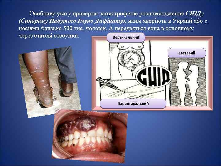 Особливу увагу привертає катастрофічне розповсюдження СНІДу (Синдрому Набутого Імуно Дифіциту), яким хворіють в Україні