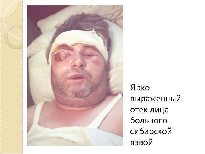 Ярко выраженный отек лица больного сибирской язвой 